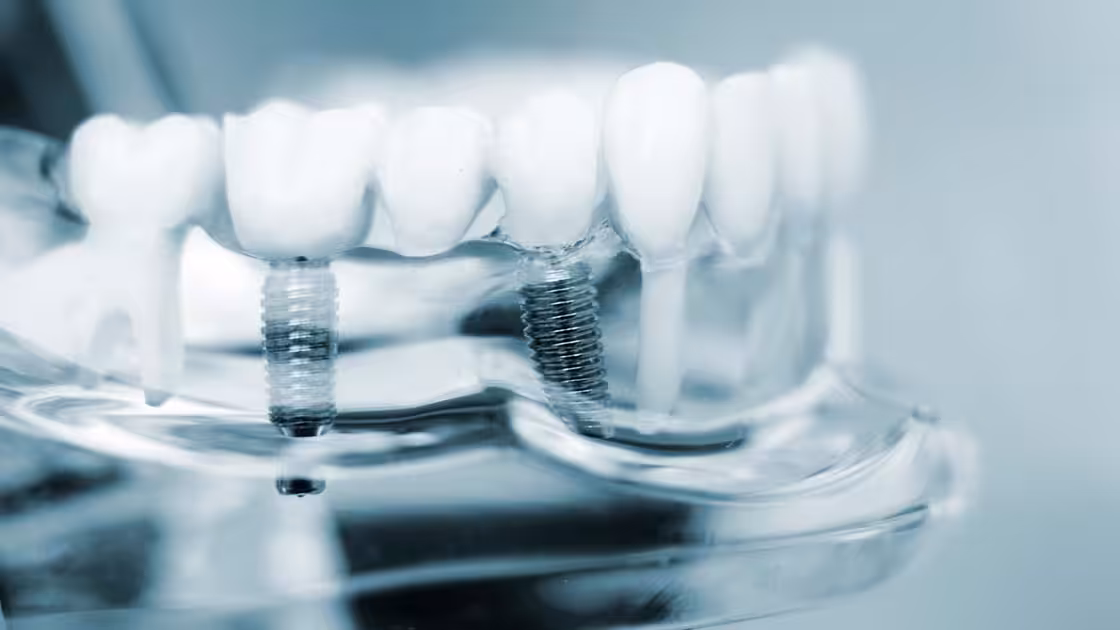 Dental Implants