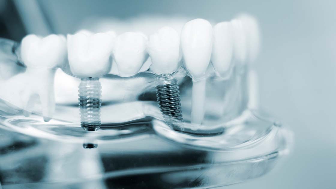 Dental Implants 