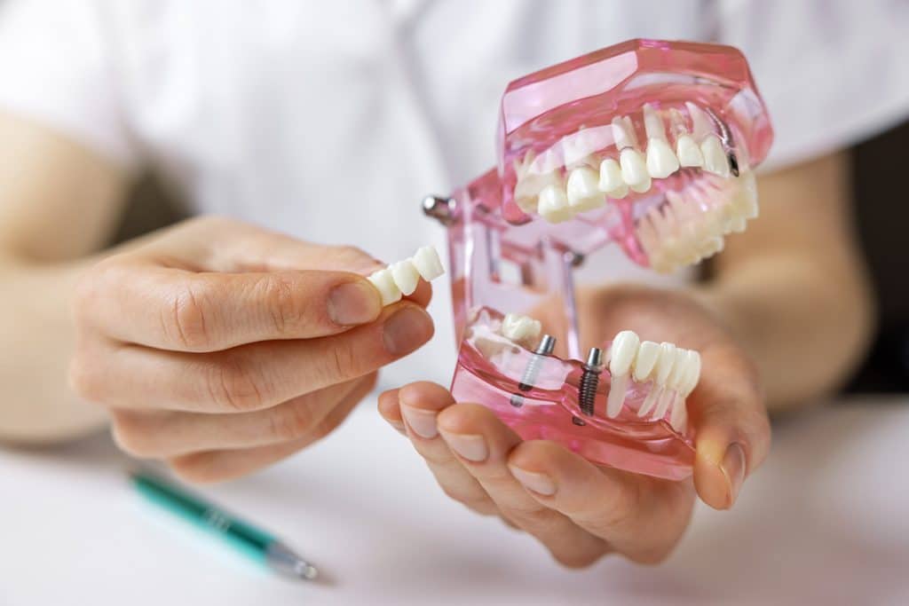 Dental Bridges vs. Dental Implants: Pros, Cons, Longevity