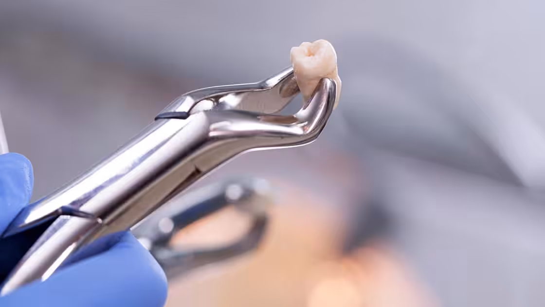 Extracted Tooth