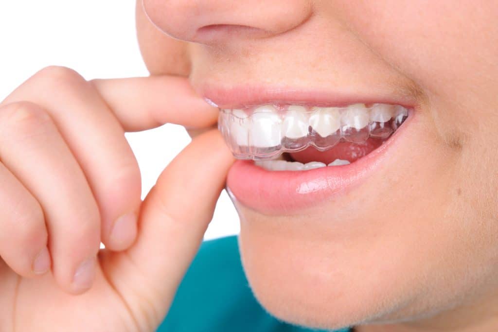 How Much Does Invisalign Cost?