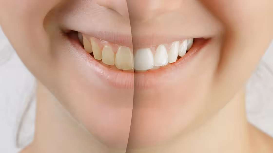 Before and After Image of Whitened Teeth